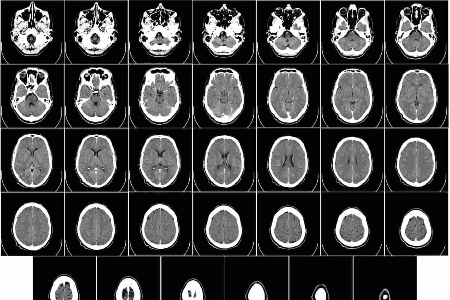 imagen de una placa neurítica, hace alusión a la neuropsicología infantil y del adulto