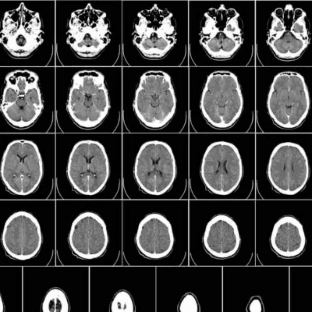 imagen de una placa neurítica, hace alusión a la neuropsicología infantil y del adulto