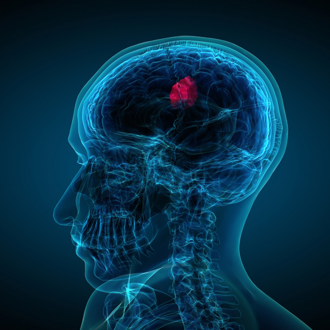 silueta de una cabeza humana en tonos azules, en medio del cerero se logra ver una mancha rojo, lo que supone ser un tumor cerebral
