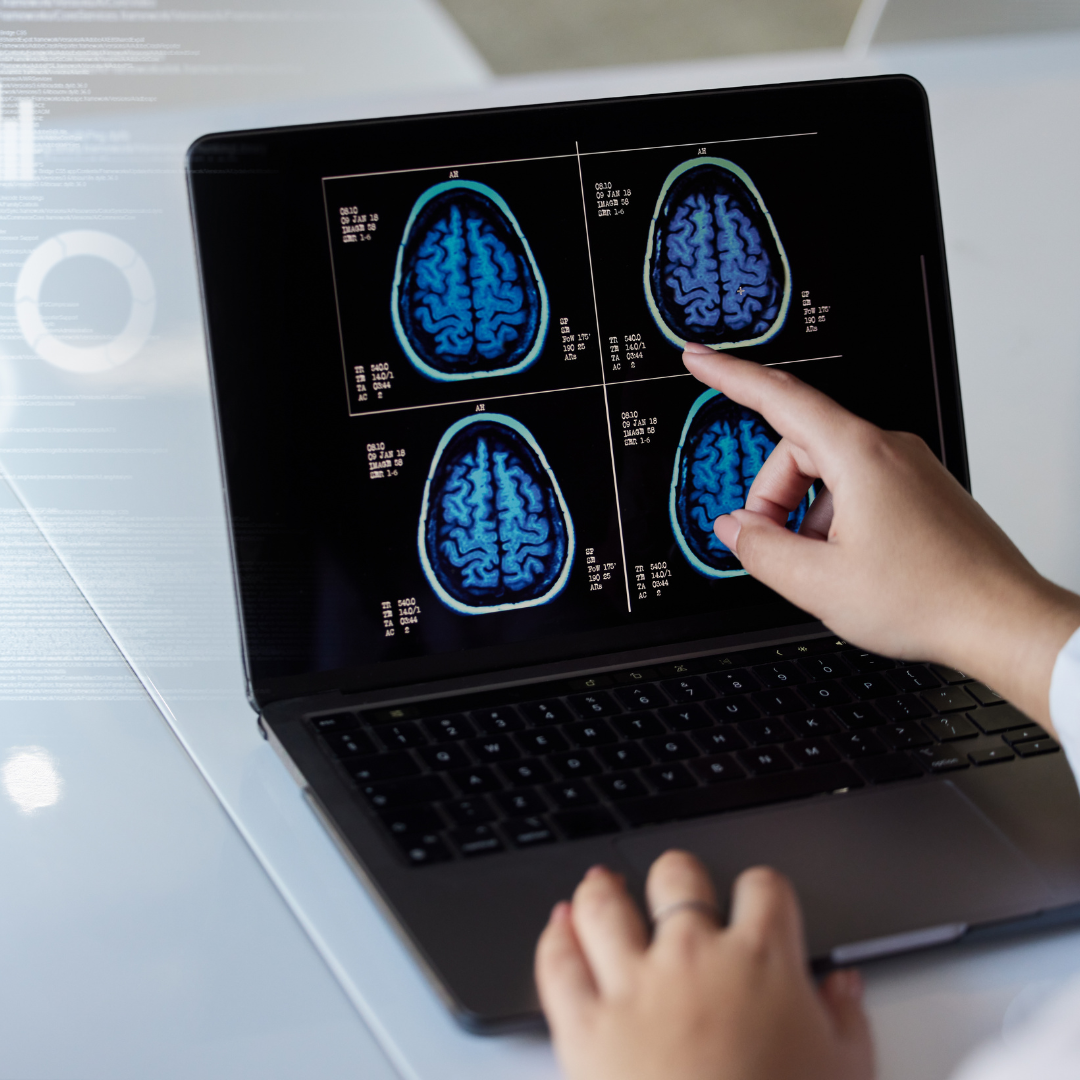 placa de un cerebro, que esta siendo vista desde un ordenador y señalada por un profesional de la salud. Imagen que hace alusión a la importancia de La salud cerebral en todas las edades